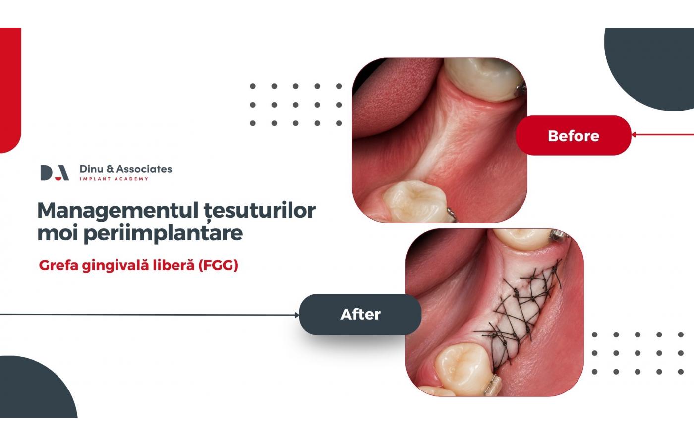 Managementul țesuturilor moi periimplantare. Grefa gingivală liberă (FGG)