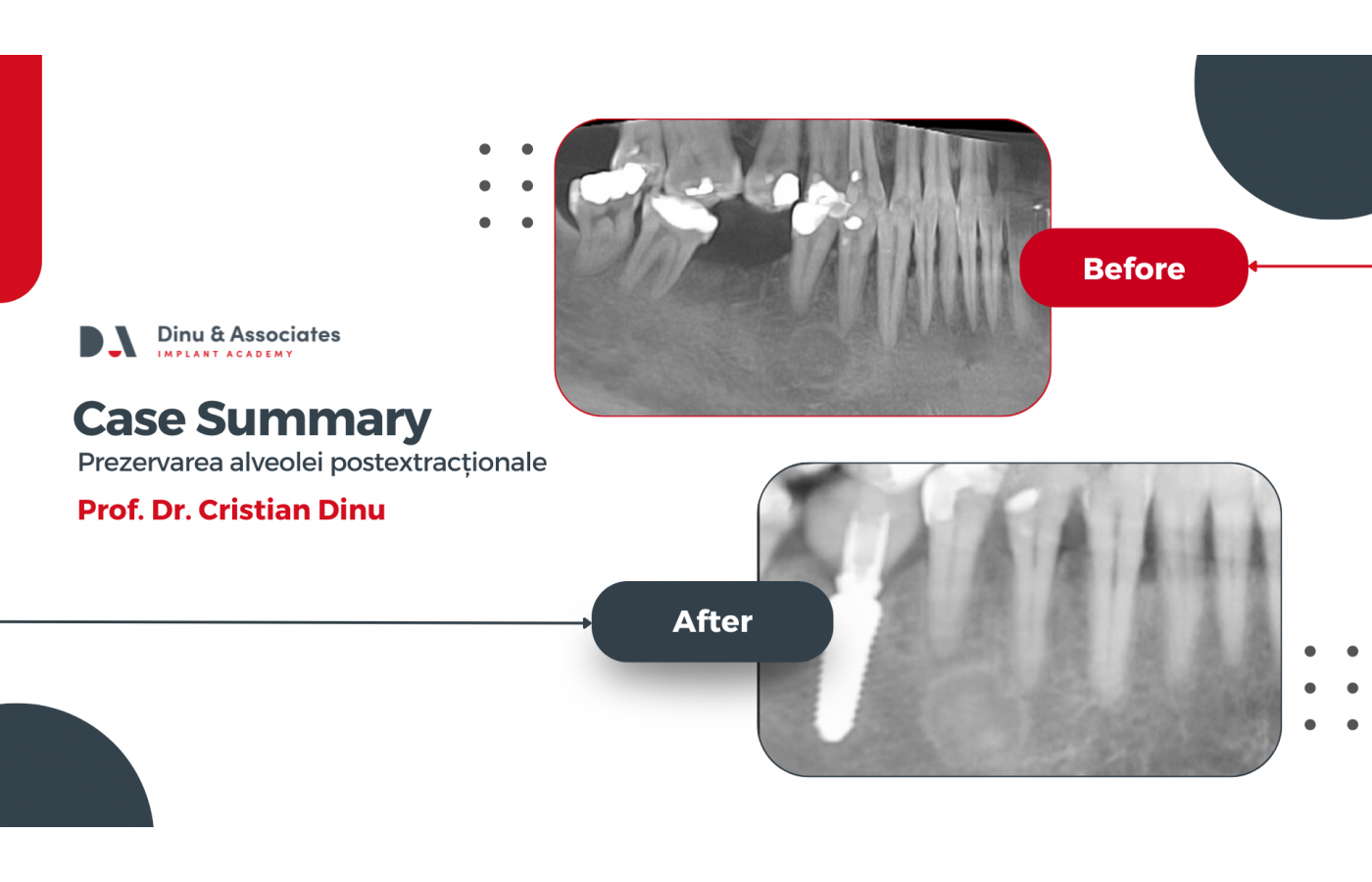 Studiu de caz și video: Prezervarea alveolei postextrationale. Intervenție realizată de prof. dr. Cristian Dinu
